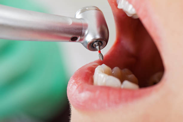 Best Emergency Root Canal Treatment in Woodlawn, OH